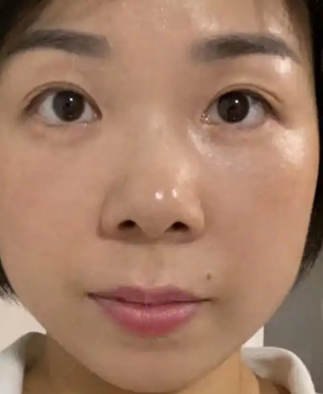 去眼袋手术
