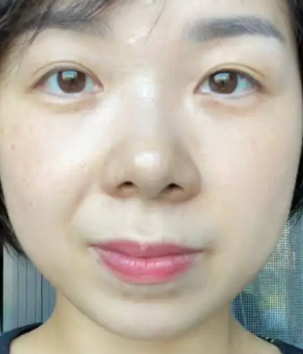 去眼袋手术