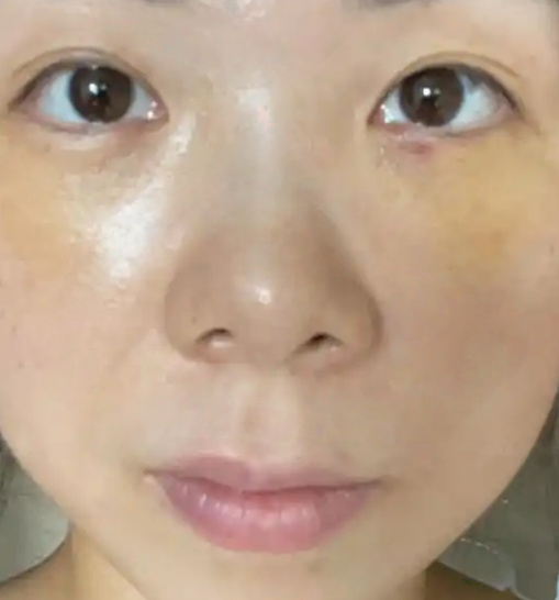 去眼袋手术