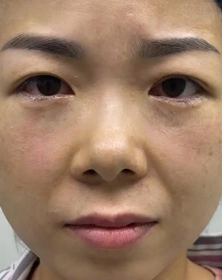 去眼袋手术