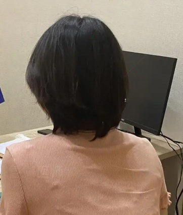 去眼袋手术