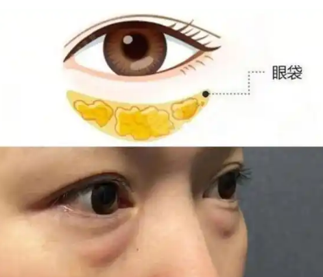 去眼袋手术