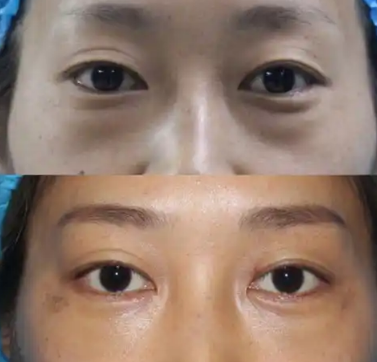 去眼袋手术