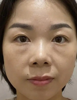 去眼袋手术