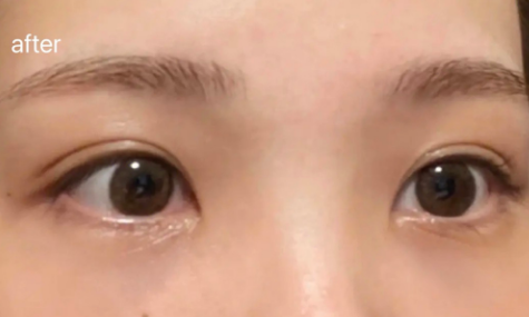 去眼袋手术