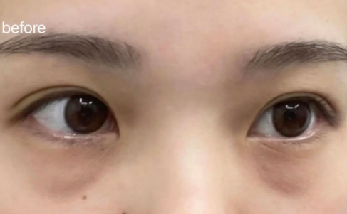 去眼袋手术