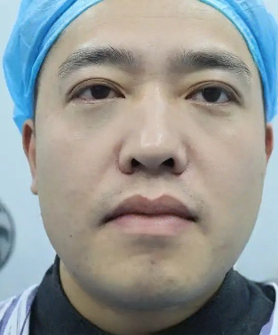 去眼袋手术