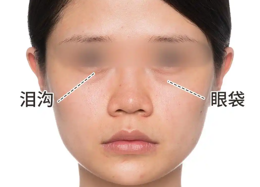 去眼袋手术