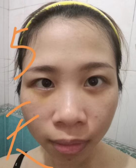 去眼袋手术