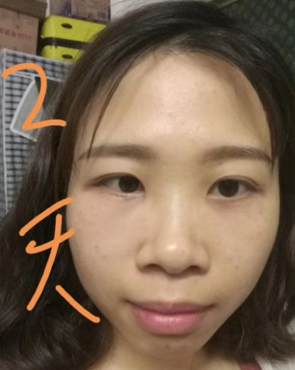 去眼袋手术