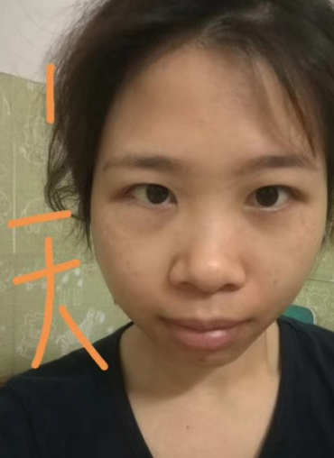 去眼袋手术
