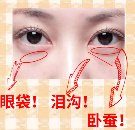 去眼袋手术
