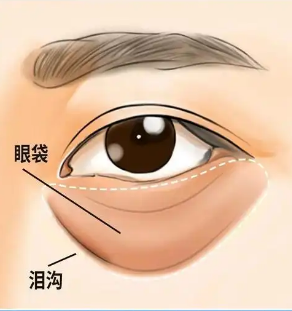 去眼袋手术