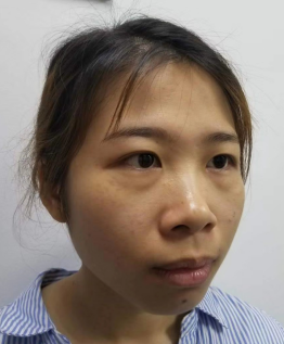 去眼袋手术