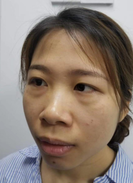 去眼袋手术