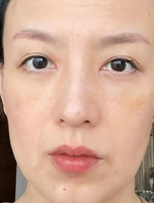 去眼袋手术