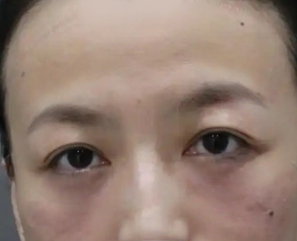去眼袋手术