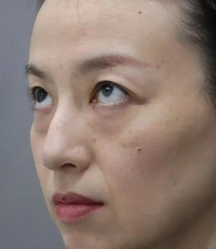 去眼袋手术
