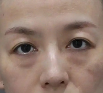 去眼袋手术