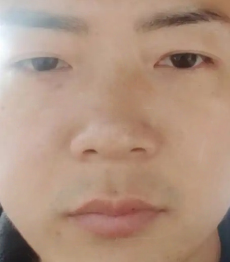去眼袋手术