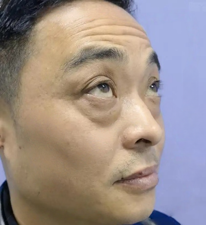 去眼袋手术