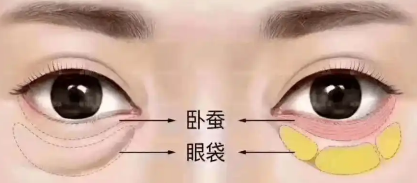 去眼袋手术
