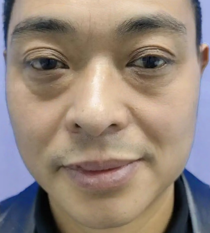 去眼袋手术