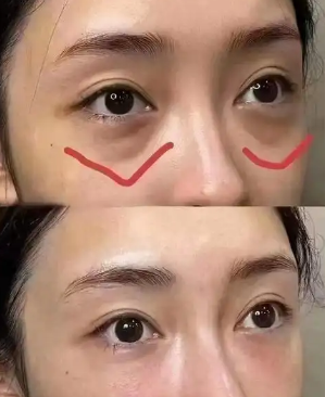 去眼袋手术