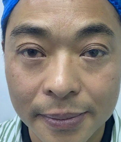 去眼袋手术