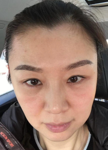 去眼袋手术