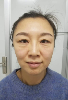 去眼袋手术