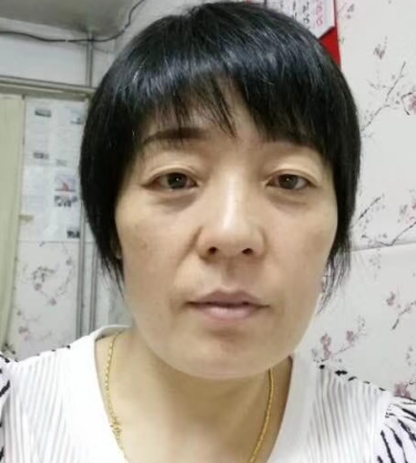 去眼袋手术