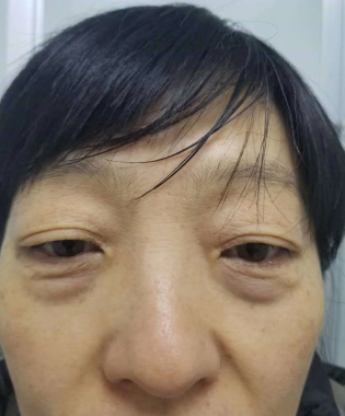 去眼袋手术