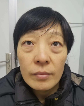 去眼袋手术