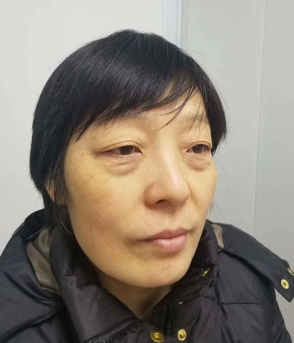 去眼袋手术