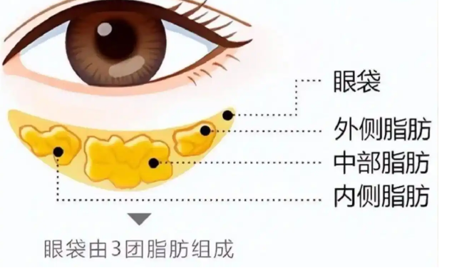 去眼袋手术