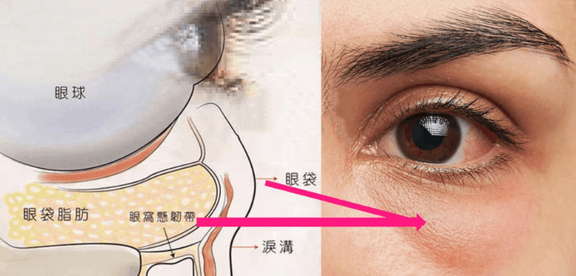 去眼袋手术