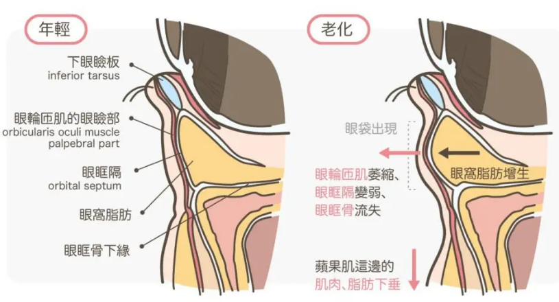 去眼袋手术