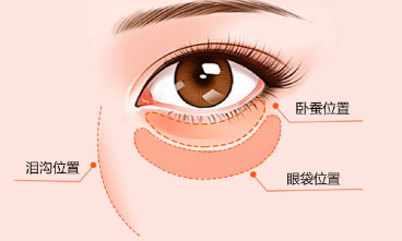 去眼袋手术