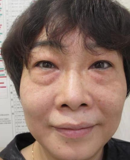 去眼袋手术
