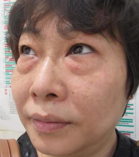 去眼袋手术