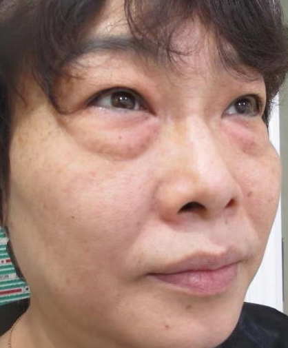去眼袋手术