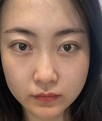 去眼袋手术