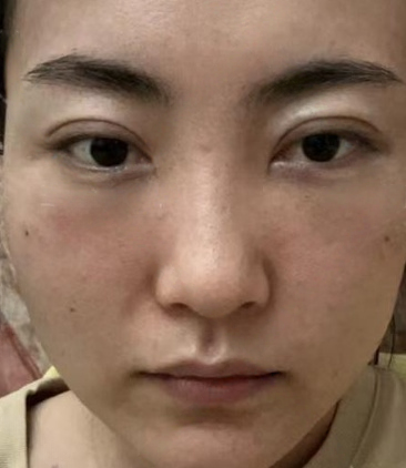 去眼袋手术
