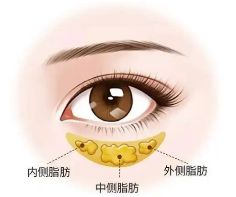去眼袋手术