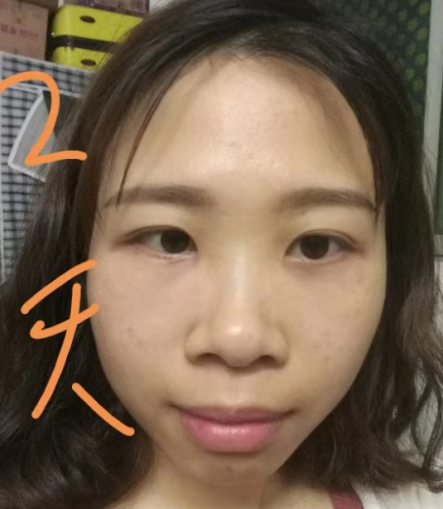 去眼袋手术