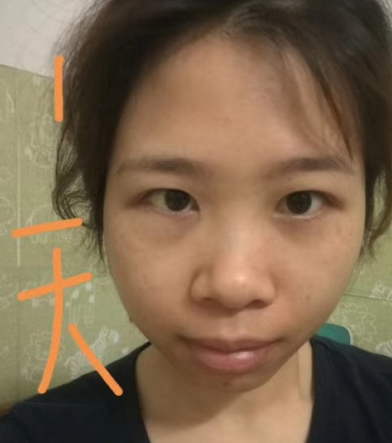 去眼袋手术