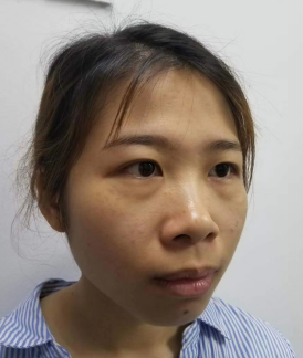 去眼袋手术