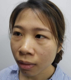 去眼袋手术