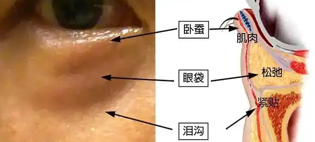 去眼袋手术